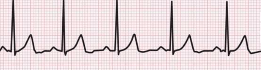 A graphical representation of an electrocardiogram (ECG) showing various heart rhythms on grid paper.